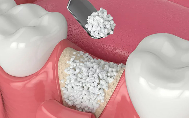 Dental Procedure | Dental Bone Grafting | Oral Surgery Solutions