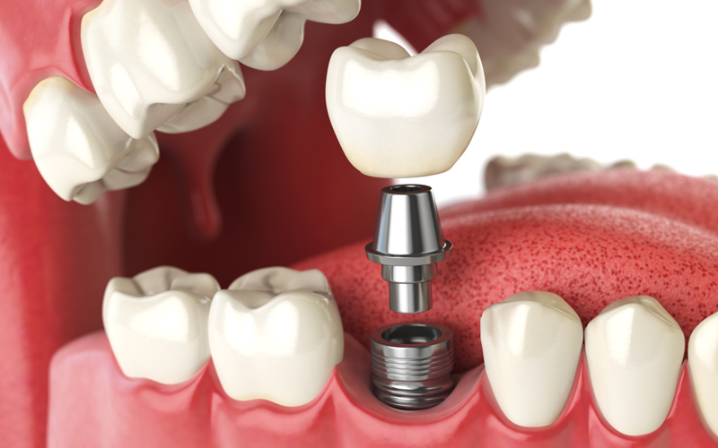 First Molar Implants | Dental Implants