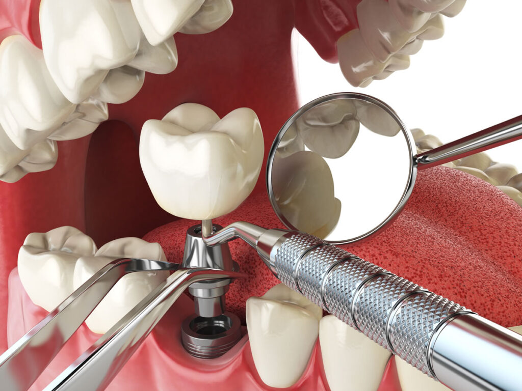 Tooth extractions are a safe and simple procedure