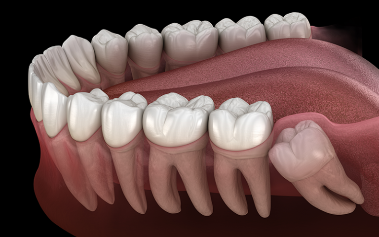 impacted wisdom tooth