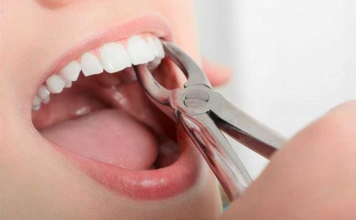 Pre Molar Extractions | Dental Extractions | Oral Surgery Solutions